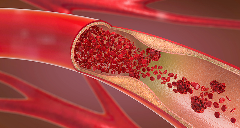 How does stress affect your cholesterol?